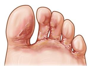 humedad - Enfermadades de las uñas de los pies