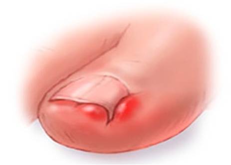 uña encarnada - Enfermadades de las uñas de los pies